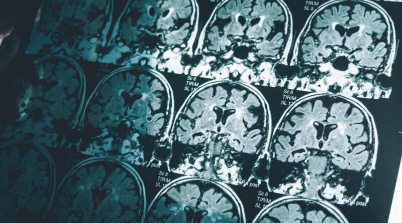 Single Brain Scan Can Diagnose Alzheimer’s Disease