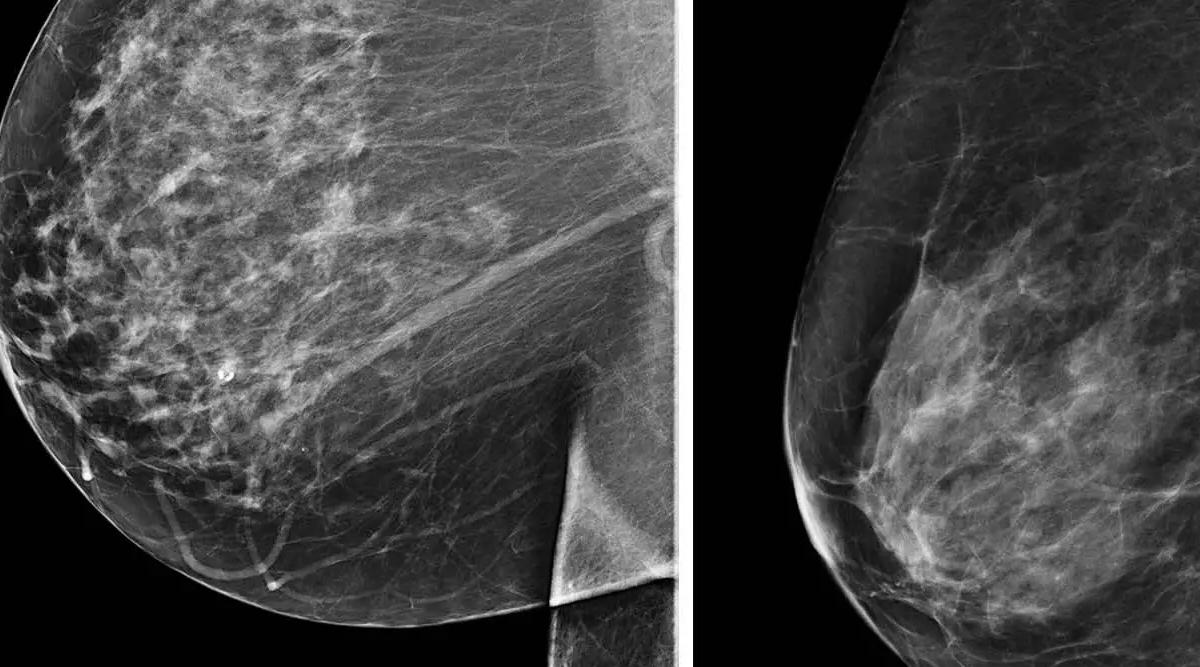 AI Outperforms Humans in Predicting Breast Cancer - The Tech Tribune