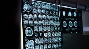 10-Minute Brain Scan Could Detect Dementia Years Before Symptoms Appear, Study Suggests